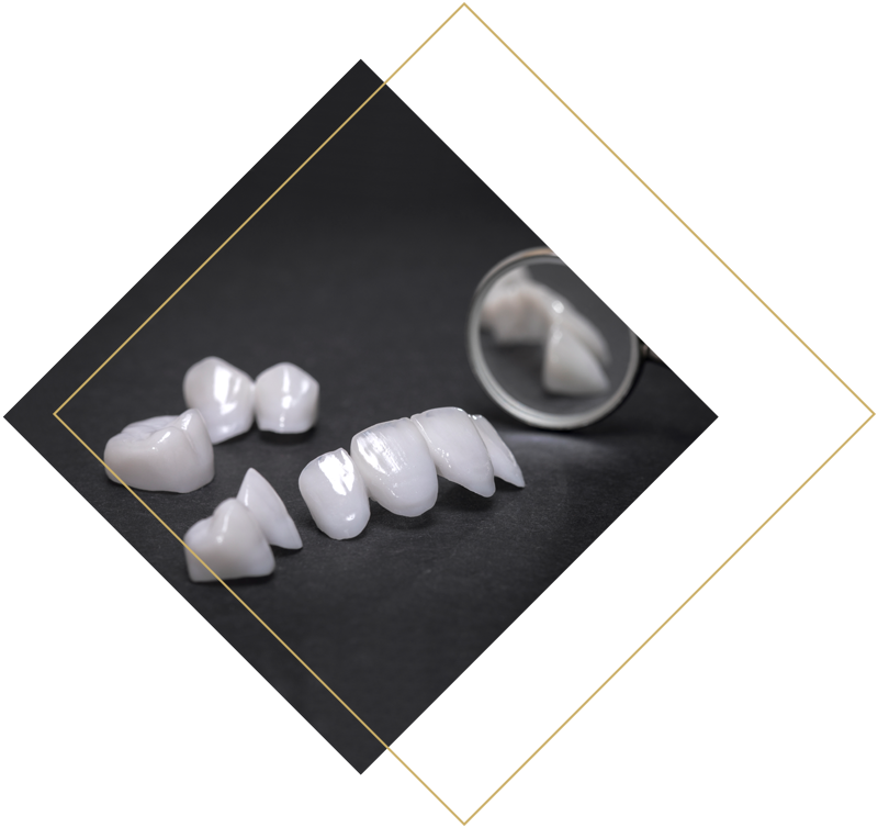 Veneers | MURATI Zahnmedizin in Illerrieden
